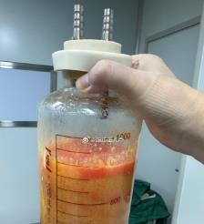 大庆水动力吸脂手术要做多久？